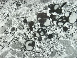 M,15y. | Wilson disease susp. M,15y. | Wilson disease susp.